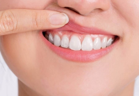 Cười hở lợi là gì? Nguyên nhân gây cười hở lợi bạn cần biết 